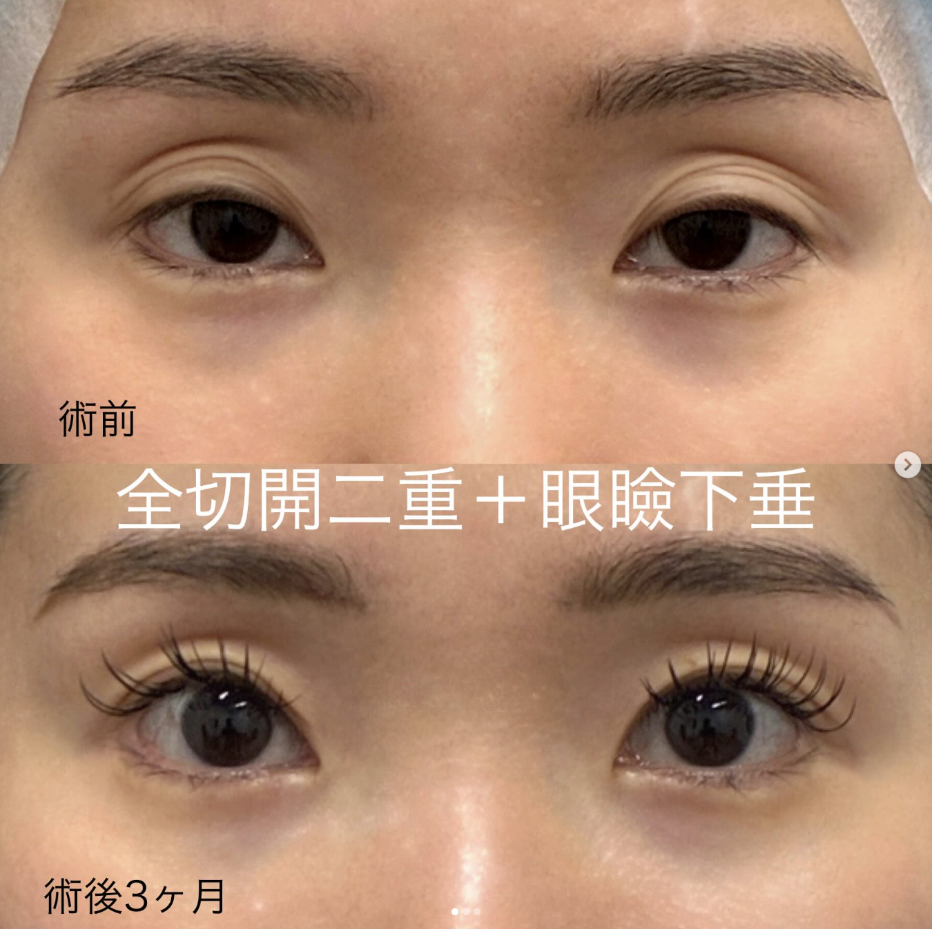 杉尾医師による全切開二重・眼瞼下垂術前/術後