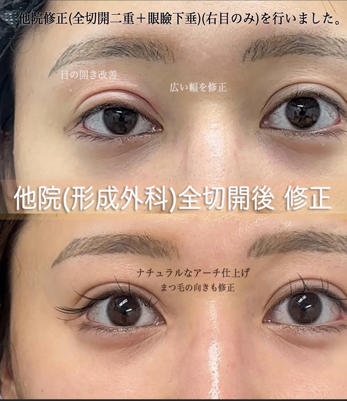 上原医師による眼瞼下垂他院修正術前/術後