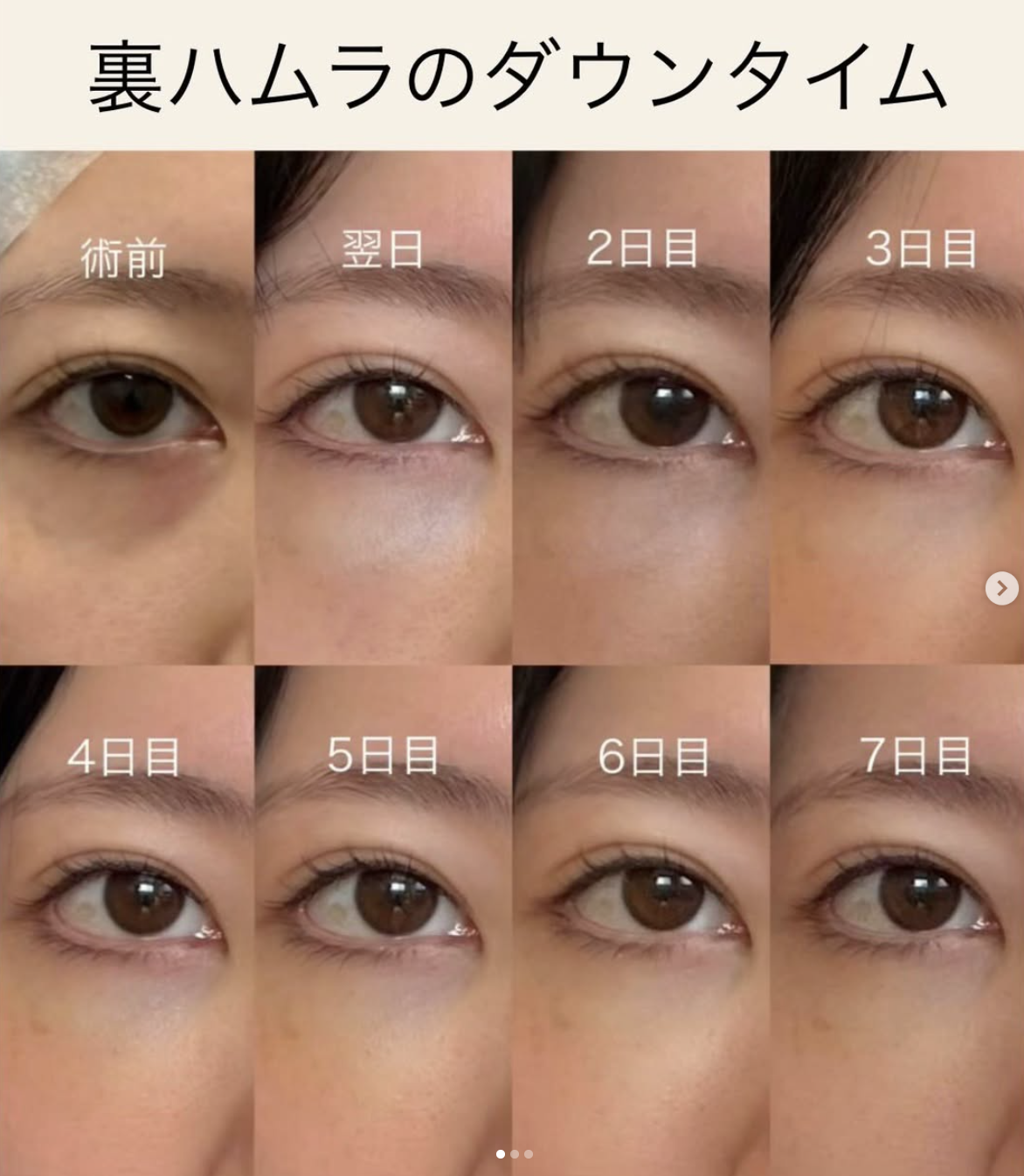 杉尾医師による裏ハムラ法術前/術後