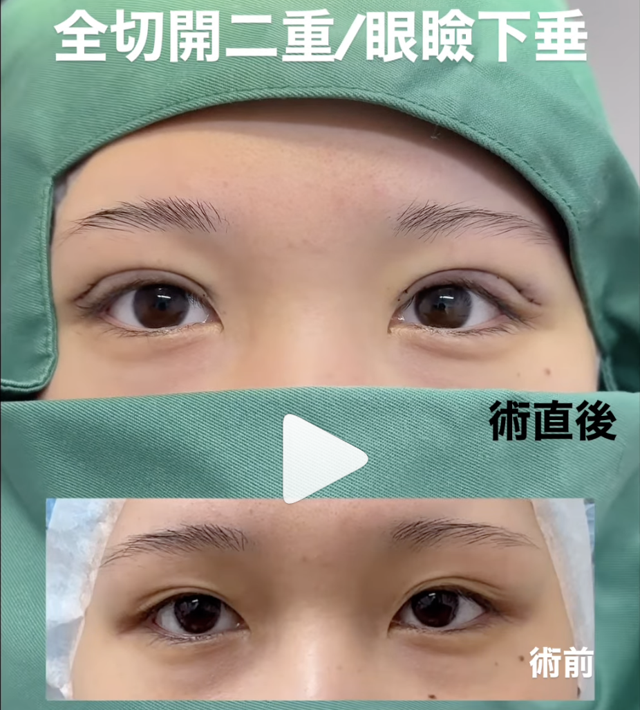 榛澤医師による全切開二重・眼瞼下垂術前/術直後
