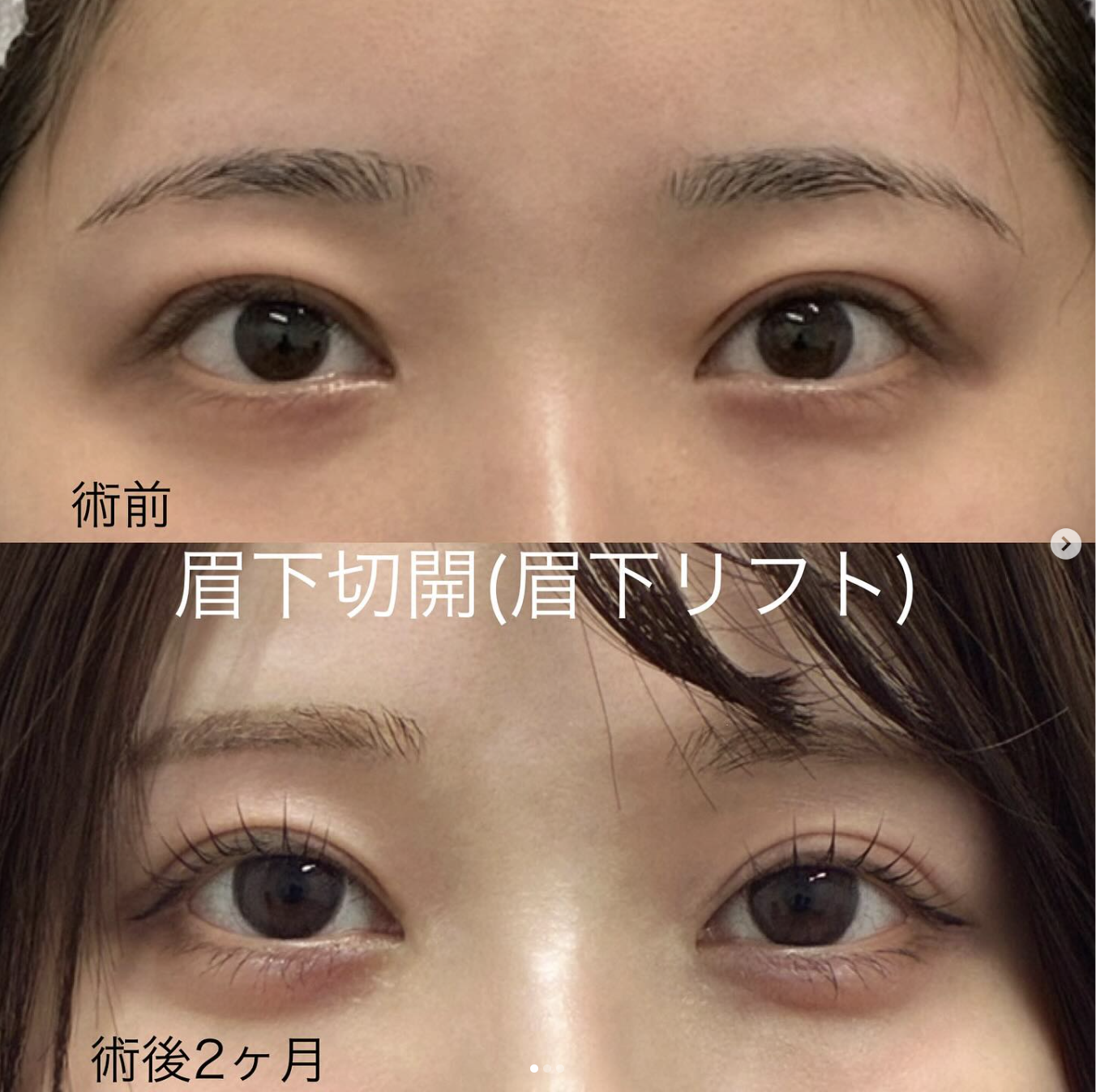 杉尾医師による眉下切開術前/術後