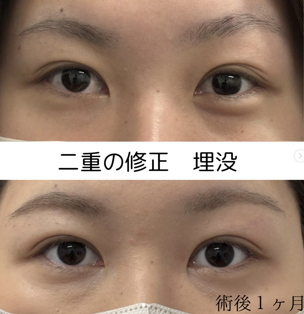 フォーエバー埋没二重