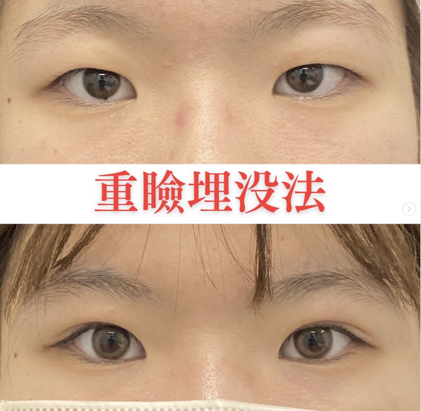 フォーエバー埋没二重