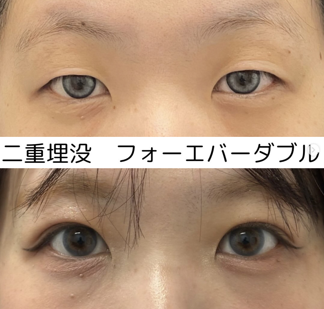 フォーエバー埋没二重