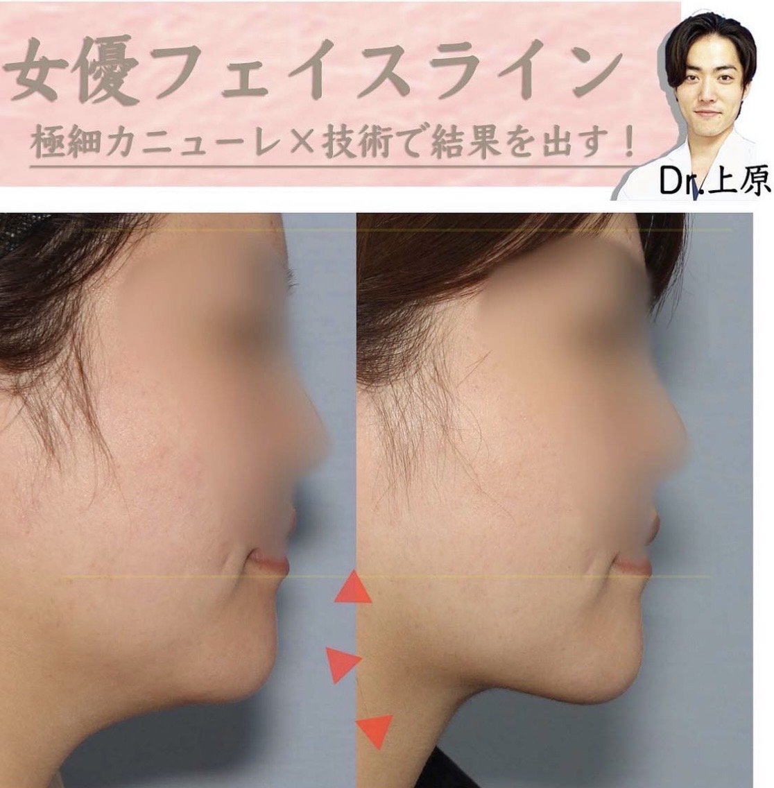フェイスライン脂肪吸引