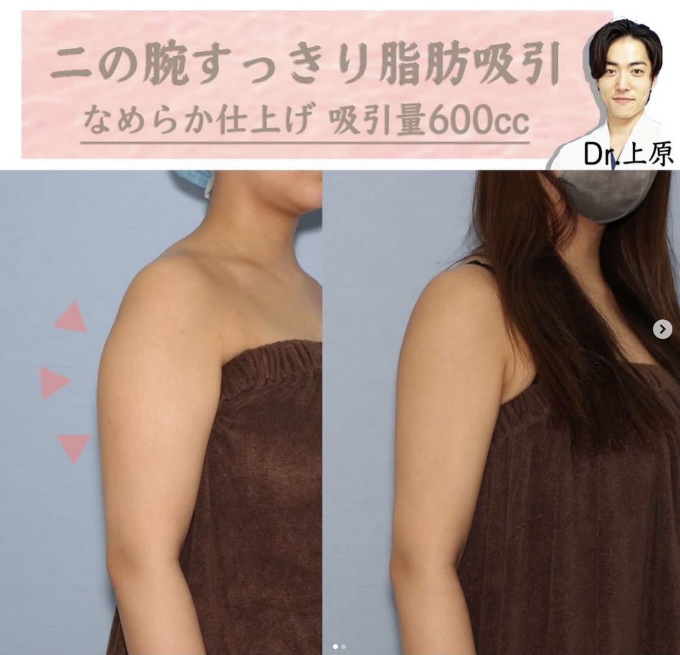 二の腕脂肪吸引