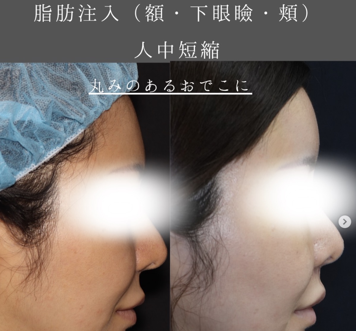 額こめかみへのCRF脂肪注入/人中短縮