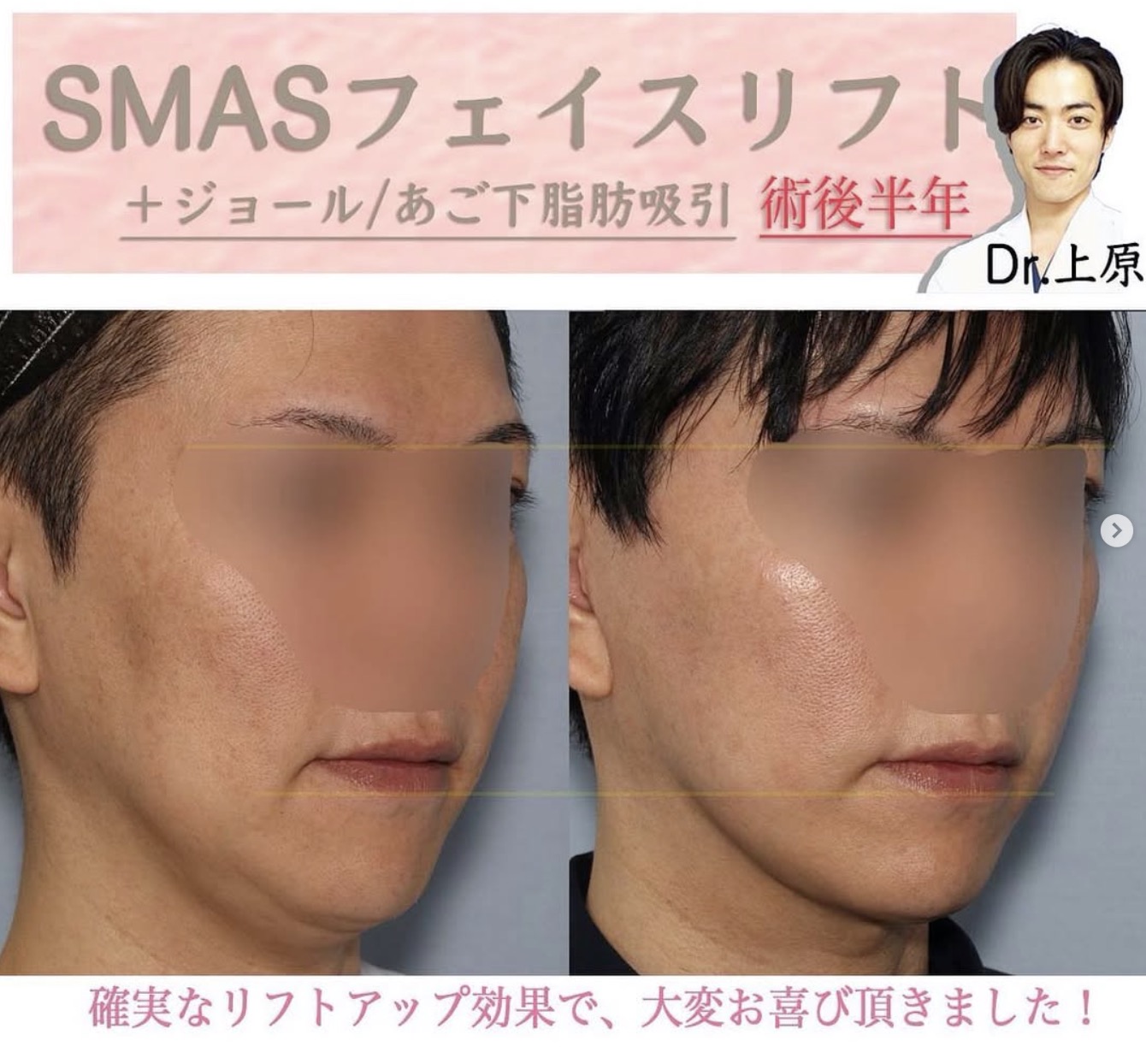 SMASフェイスリフト・あご下脂肪吸引